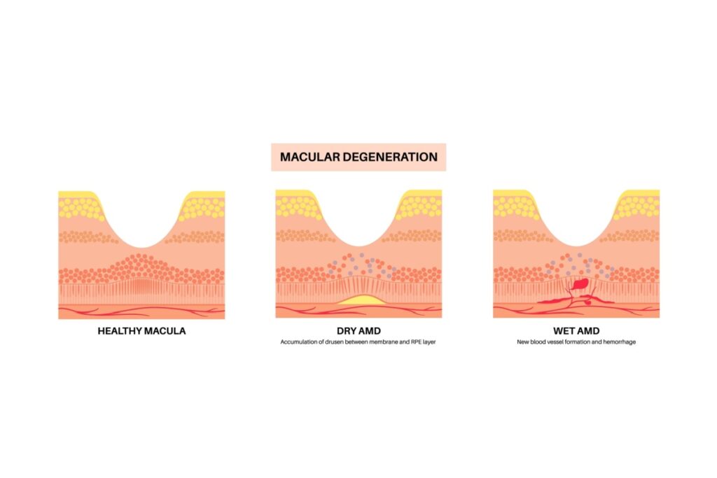 Diagram comparing a healthy macula, dry age-related macular degeneration with drusen buildup, and wet macular degeneration with abnormal blood vessels.