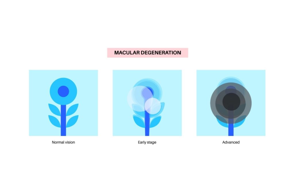 Illustration showing how macular degeneration affects vision, with examples of normal vision, early stage, and advanced stage vision loss.