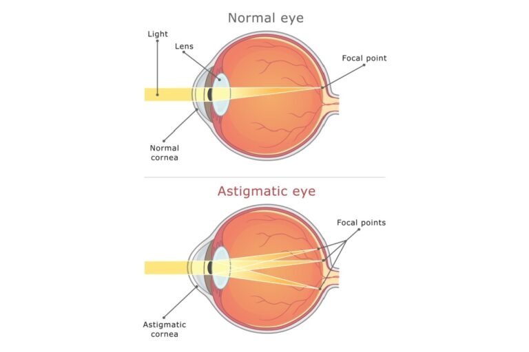 Can You Wear Contacts with Astigmatism?